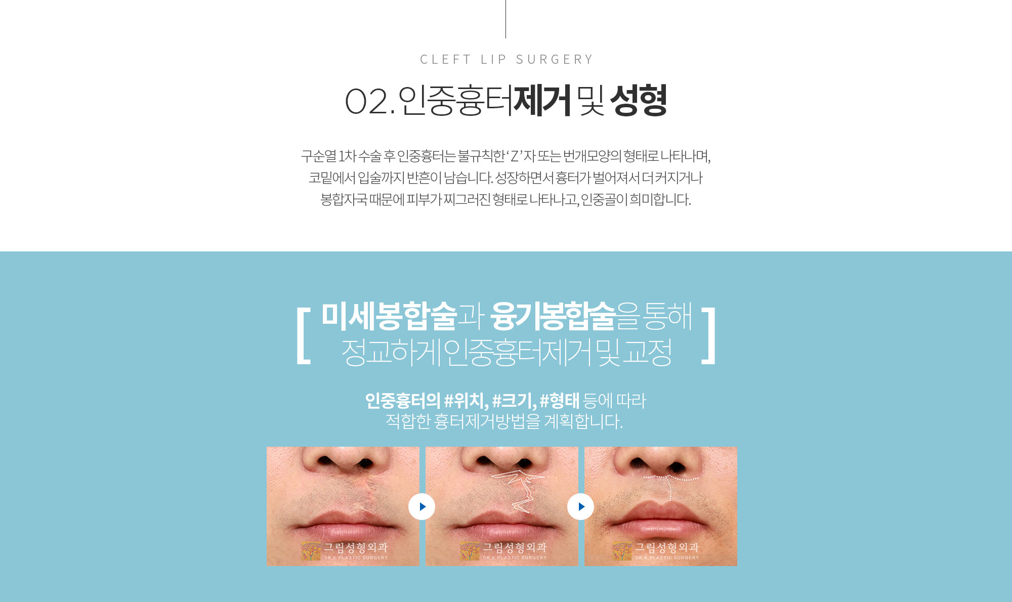 CLEFT LIP SURGERY 02.  